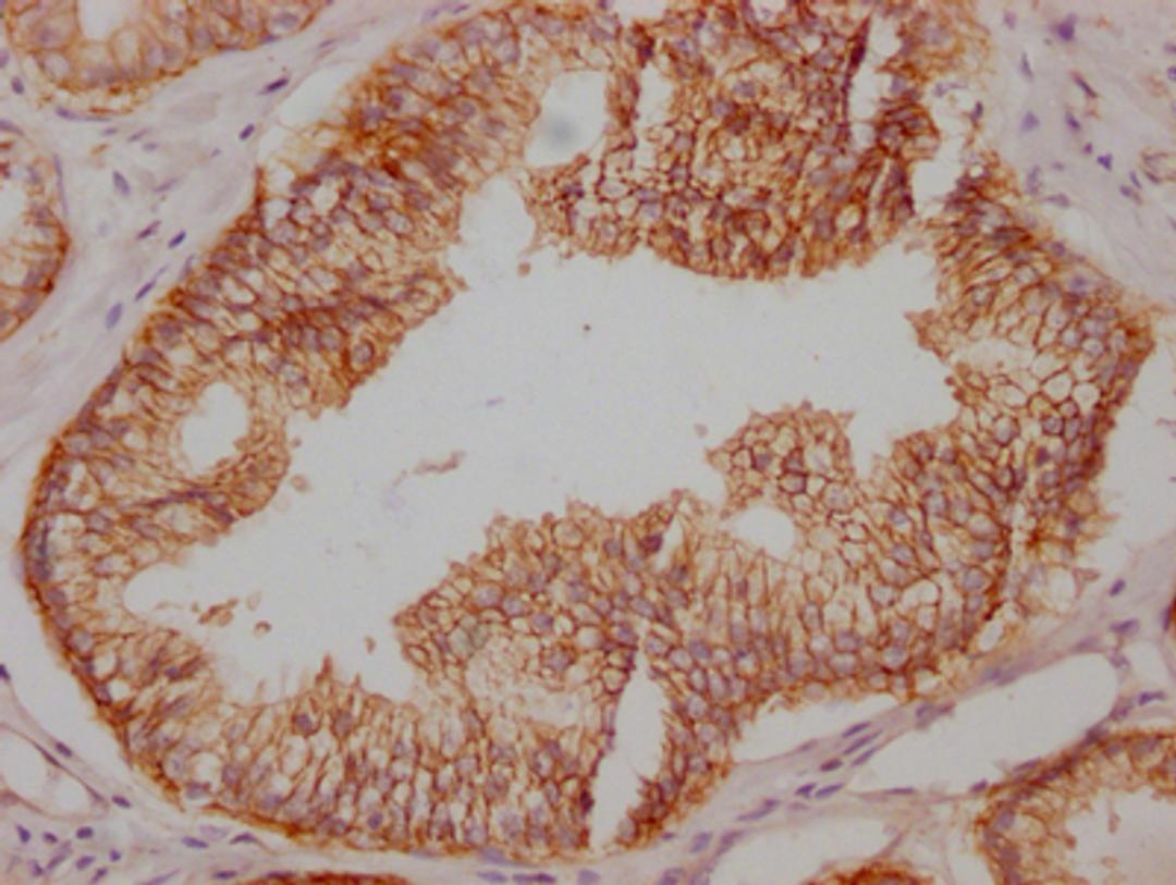 IHC image of CSB-RA827145A0HU diluted at 1:100 and staining in paraffin-embedded human prostate cancer performed on a Leica BondTM system. After dewaxing and hydration, antigen retrieval was mediated by high pressure in a citrate buffer (pH 6.0). Section was blocked with 10% normal goat serum 30min at RT. Then primary antibody (1% BSA) was incubated at 4℃ overnight. The primary is detected by a Goat anti-rabbit IgG polymer labeled by HRP and visualized using 0.05% DAB.