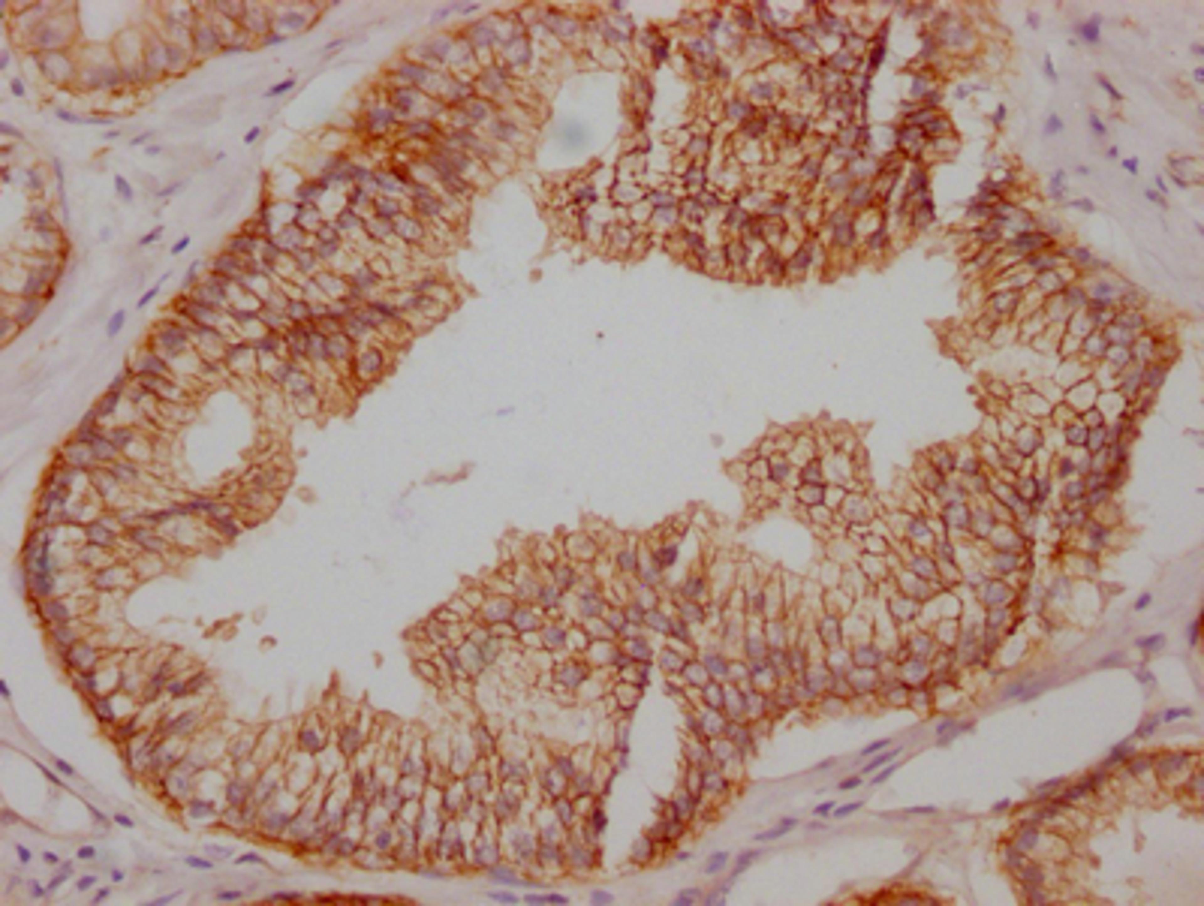 IHC image of CSB-RA827145A0HU diluted at 1:100 and staining in paraffin-embedded human prostate cancer performed on a Leica BondTM system. After dewaxing and hydration, antigen retrieval was mediated by high pressure in a citrate buffer (pH 6.0). Section was blocked with 10% normal goat serum 30min at RT. Then primary antibody (1% BSA) was incubated at 4℃ overnight. The primary is detected by a Goat anti-rabbit IgG polymer labeled by HRP and visualized using 0.05% DAB.