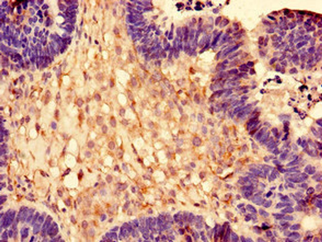 Immunohistochemistry of paraffin-embedded human ovarian cancer using CSB-PA020217EA01HU at dilution of 1:100