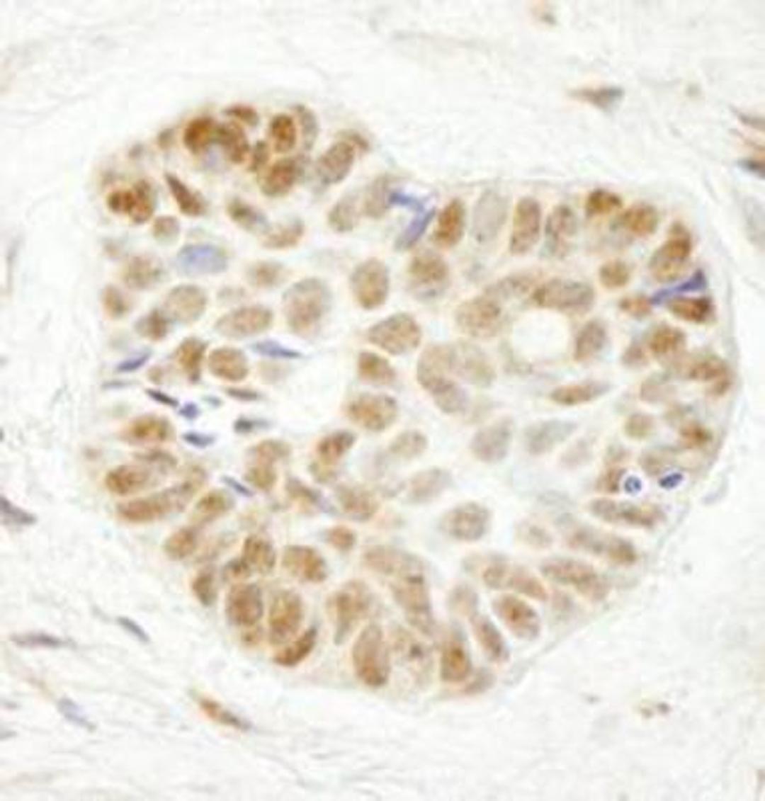 Immunohistochemistry-Paraffin: WDR79 Antibody [NB100-68252] - FFPE section of human skin carcinoma.  Affinity purified rabbit anti-WDR79 used at a dilution of 1:250.