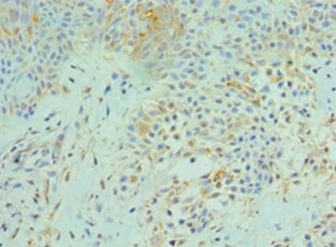 Immunohistochemistry of paraffin-embedded human breast cancer using CSB-PA847224ESR1HU at dilution of 1:100