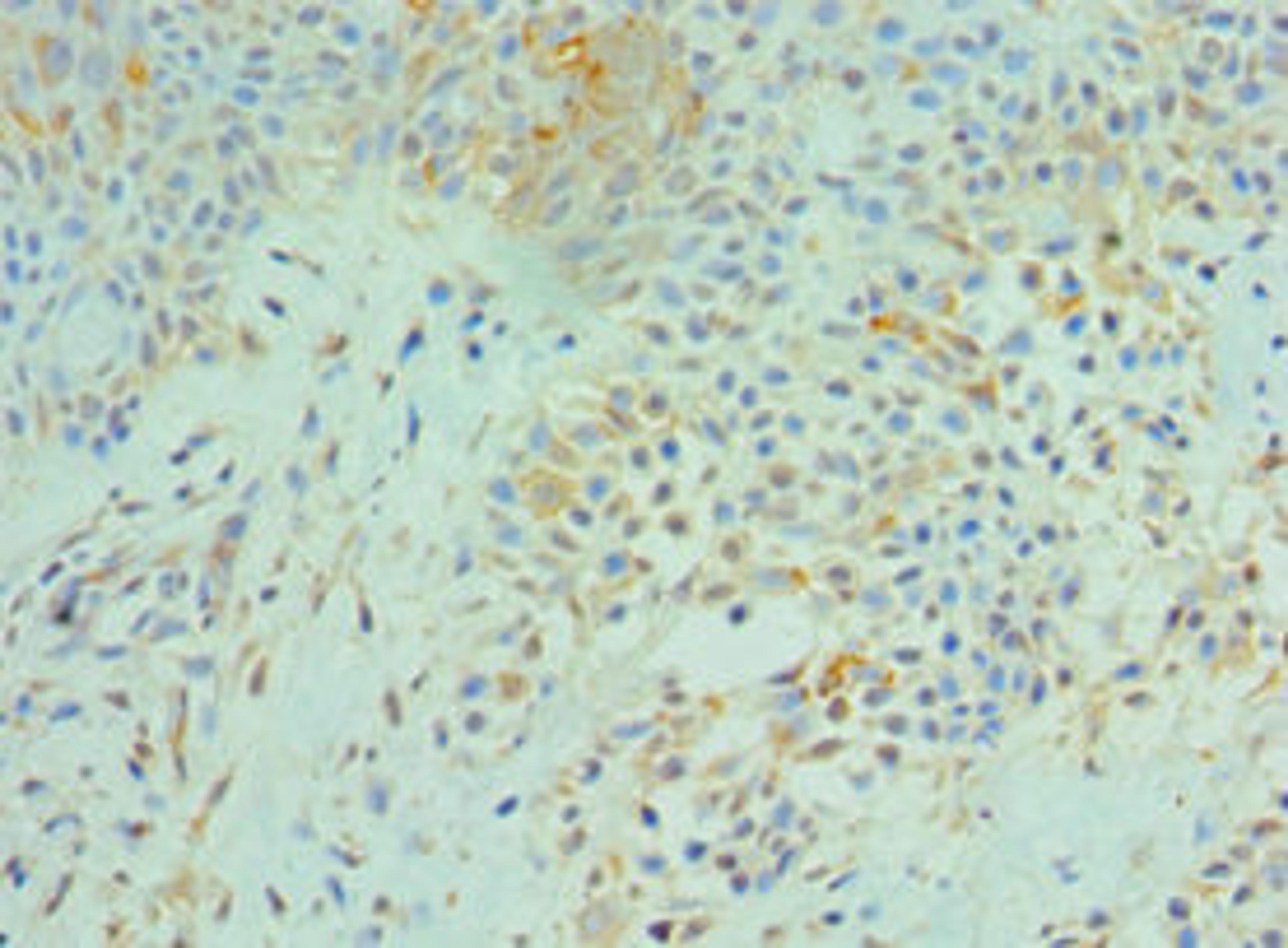 Immunohistochemistry of paraffin-embedded human breast cancer using CSB-PA847224ESR1HU at dilution of 1:100