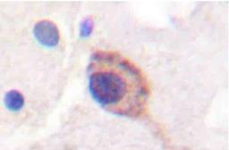 Immunohistochemistry-Paraffin: Sodium Potassium ATPase Alpha 1 [p Tyr10] Antibody [NBP2-22107] - Analyzes of Na+/K+-ATPase alpha 1 (Y10) pAb in paraffin-embedded human breast carcinoma tissue.