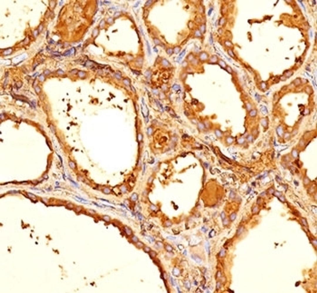 IHC staining of human thyroid tissue with Thyroglobulin antibody (6E1, aka clone TGB05).