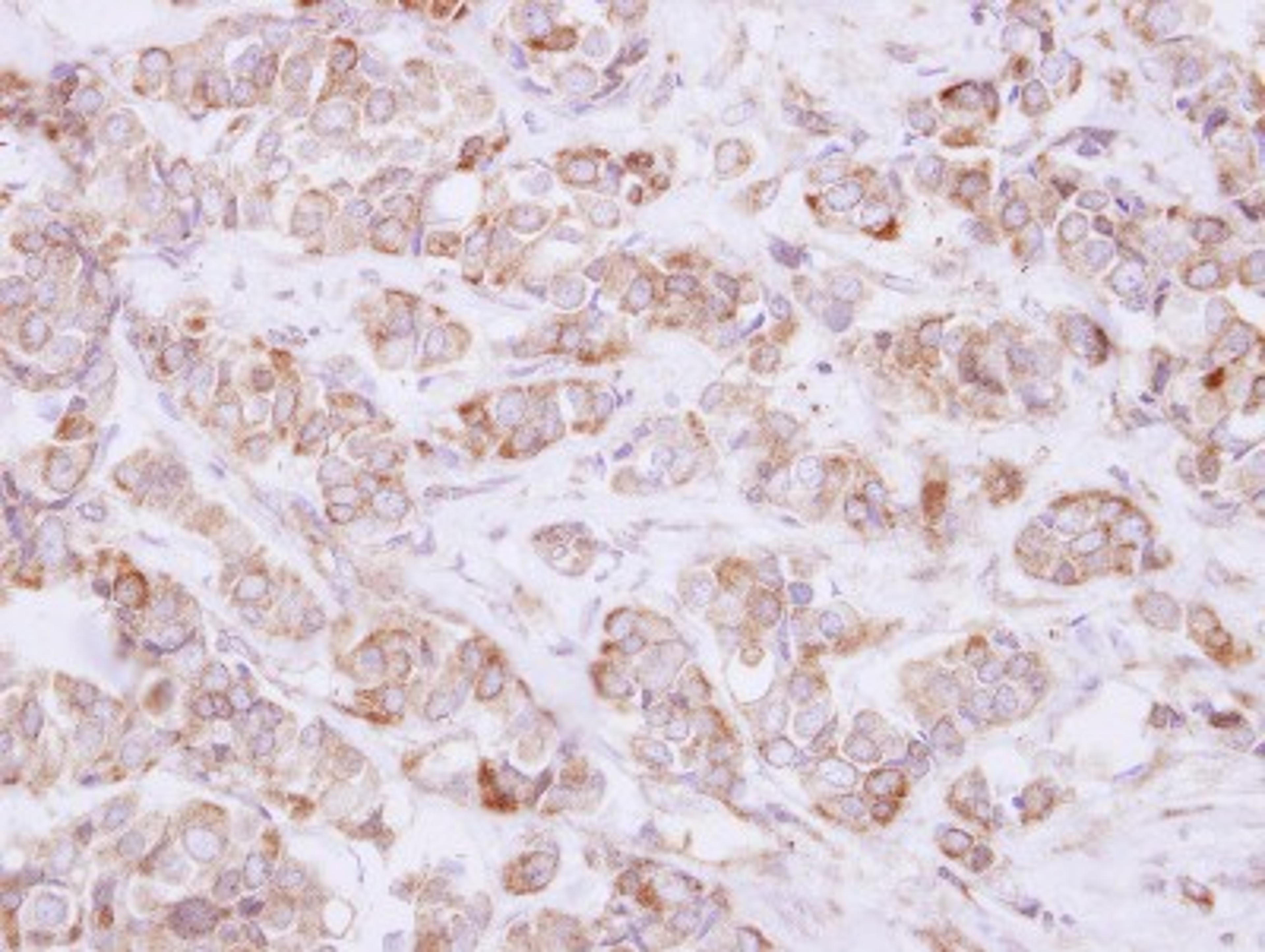 Immunohistochemistry-Paraffin: USP46 Antibody [NBP2-20835] - Immunohistochemical analysis of paraffin-embedded Breast ca, using antibody at 1:500 dilution.