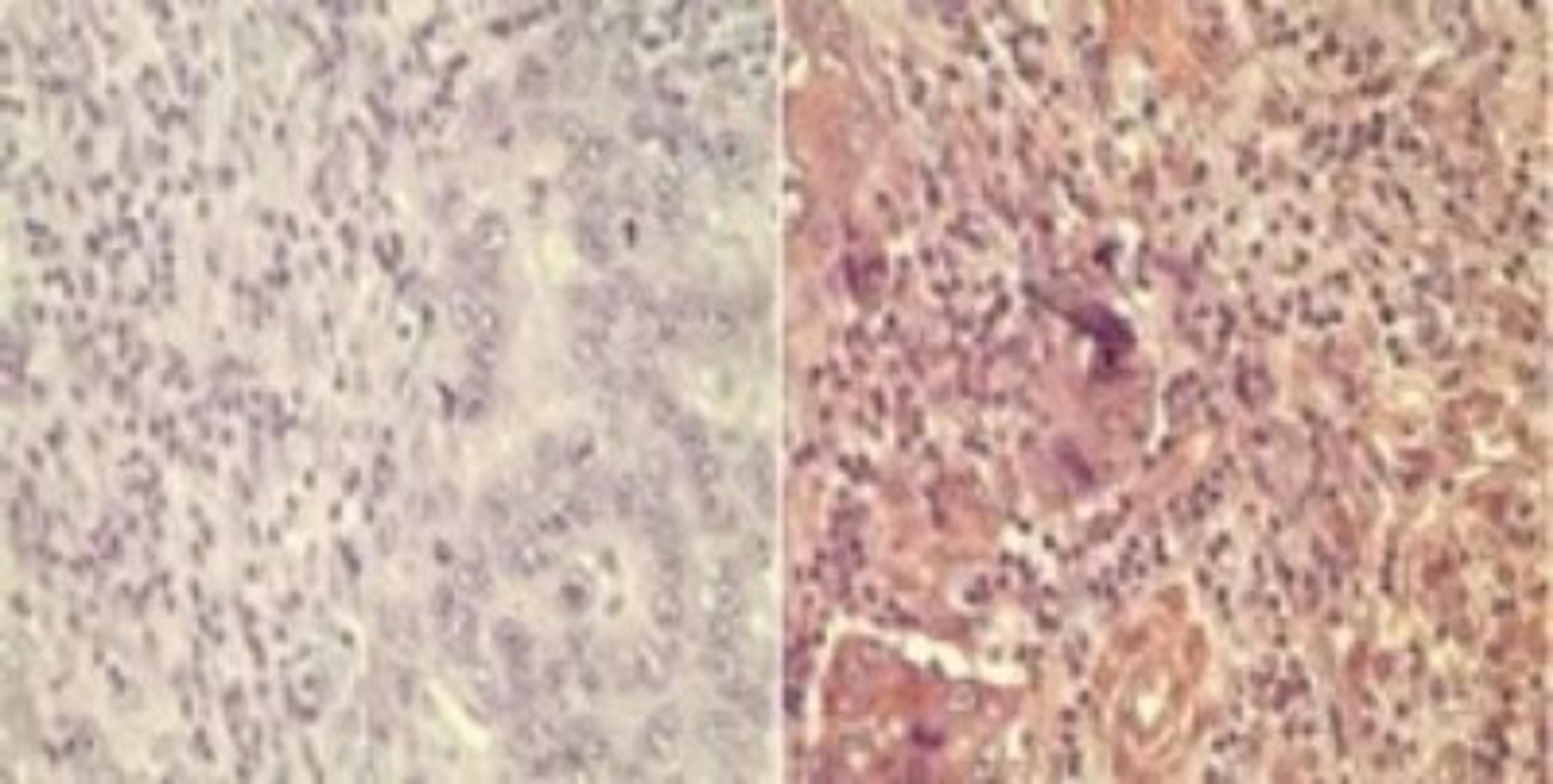 Immunohistochemistry-Paraffin: Wnt5a Antibody [NBP2-24752] - Analysis of Wnt5A in formalin-fixed, paraffin-embedded human breast tumor using an isotype control (left) and Wnt5A antibody (right) at 10 ug/ml.