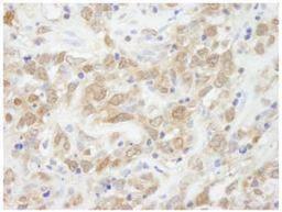 Immunohistochemistry-Paraffin: SRA1 Antibody [NB100-2270] - FFPE section of human metastatic lymph node.  Affinity purified rabbit anti-SRA used at a dilution of 1:100.