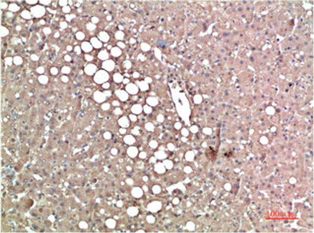 Immunohistochemical analysis of paraffin-embedded Human Liver Carcinoma Tissue using TTR Mouse mAb diluted at 1:200.