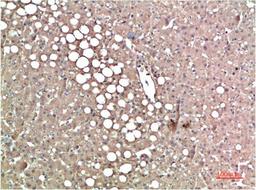 Immunohistochemical analysis of paraffin-embedded Human Liver Carcinoma Tissue using TTR Mouse mAb diluted at 1:200.