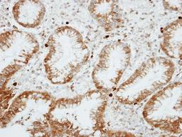 Immunohistochemistry-Paraffin: RGS14 Antibody [NBP1-31174] - Paraffin-embedded GASTRIC CA, using antibody at 1:100 dilution.