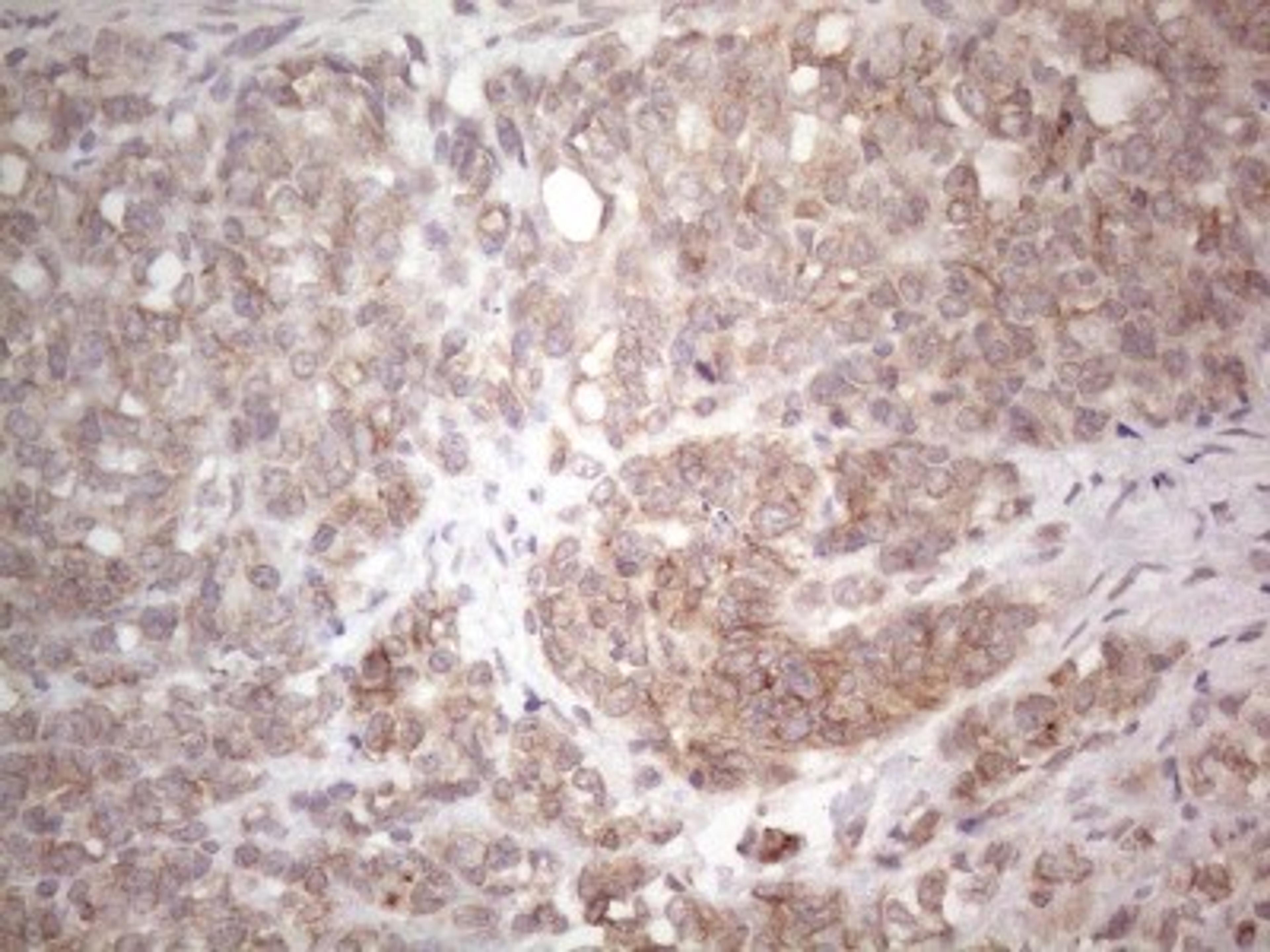 Immunohistochemistry: TLK2 Antibody (2D10) [NBP2-46141] - Analysis of Adenocarcinoma of Human endometrium tissue. (Heat-induced epitope retrieval by 1mM EDTA in 10mM Tris buffer (pH8.5) at 120C for 3 min)