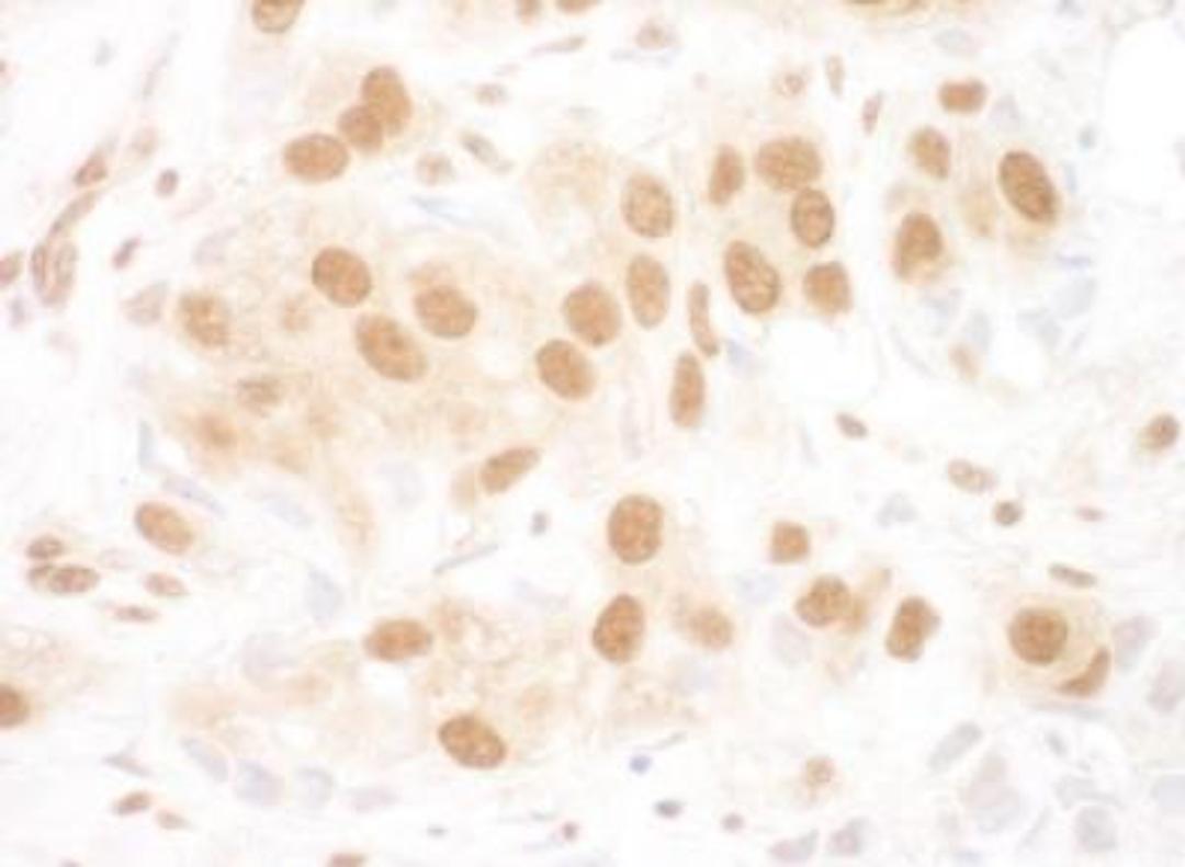 Immunohistochemistry-Paraffin: RUVBL2 Antibody [NBP1-40354] - Human breast carcinoma.