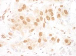 Immunohistochemistry-Paraffin: RUVBL2 Antibody [NBP1-40354] - Human breast carcinoma.