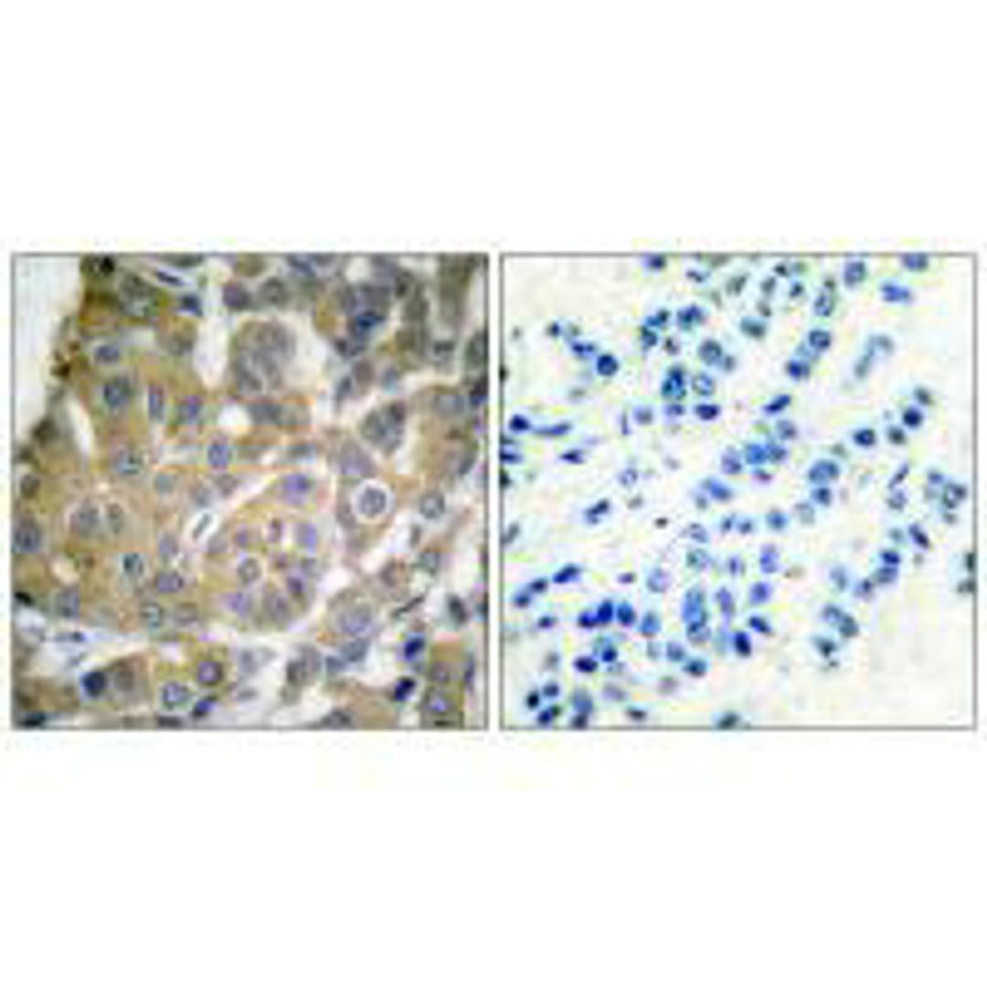 Immunohistochemical analysis of paraffin-embedded human breast carcinoma tissue using Cox2 antibody.