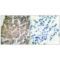 Immunohistochemical analysis of paraffin-embedded human breast carcinoma tissue using Cox2 antibody.
