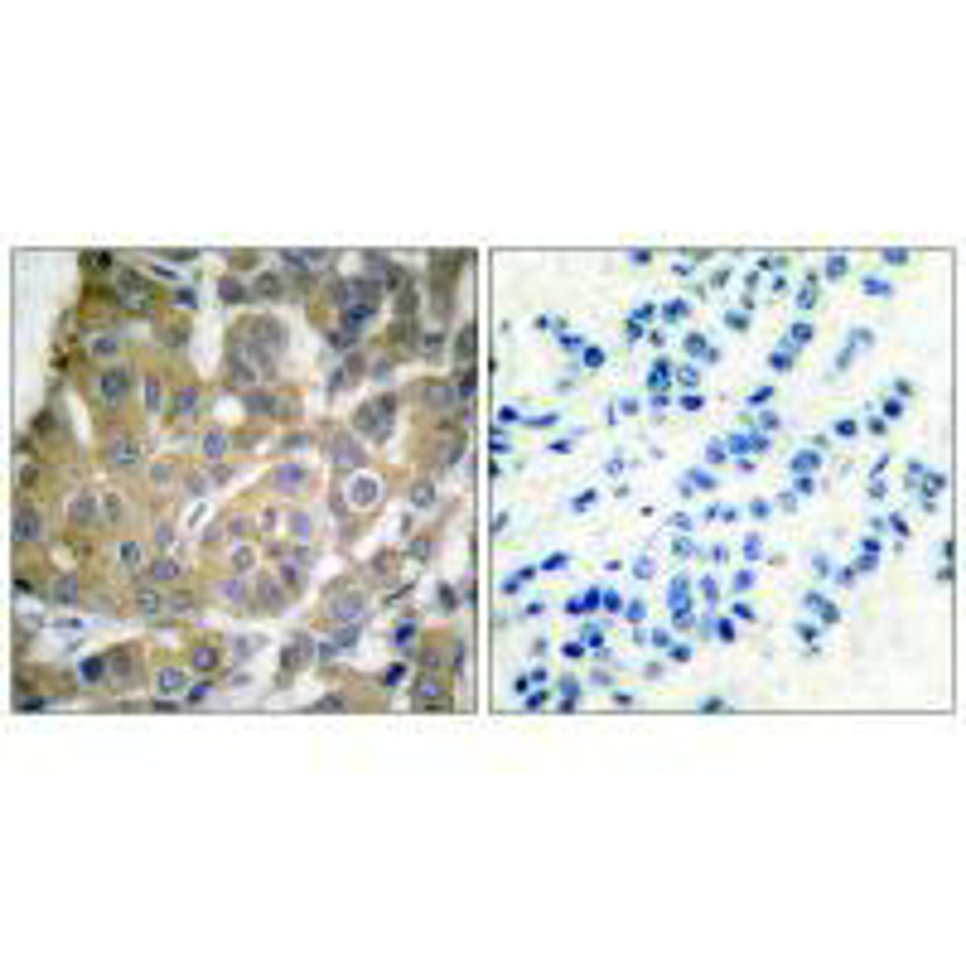 Immunohistochemical analysis of paraffin-embedded human breast carcinoma tissue using Cox2 antibody.