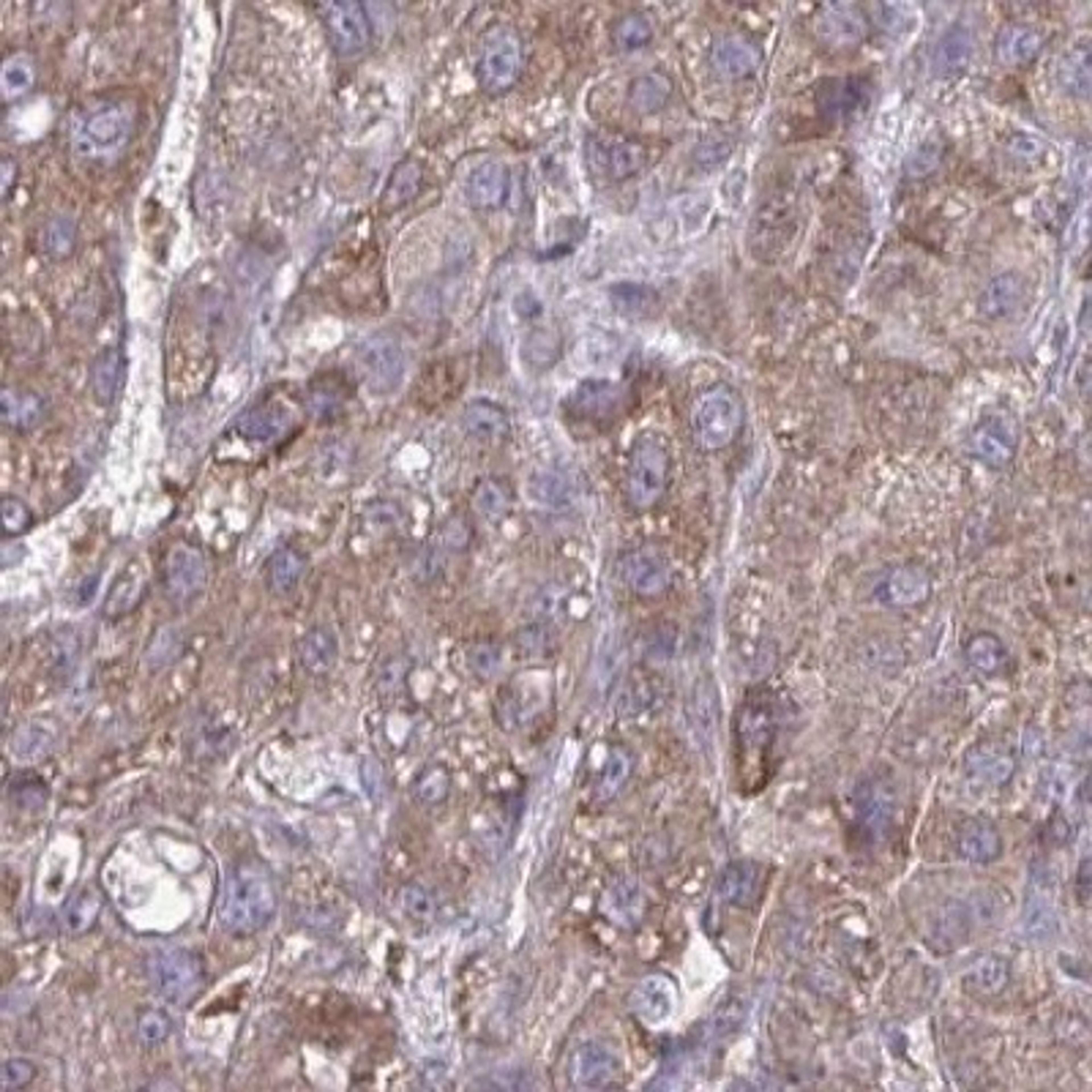 Immunohistochemistry-Paraffin: SLC7A5 Antibody [NBP2-33662] - liver cancer