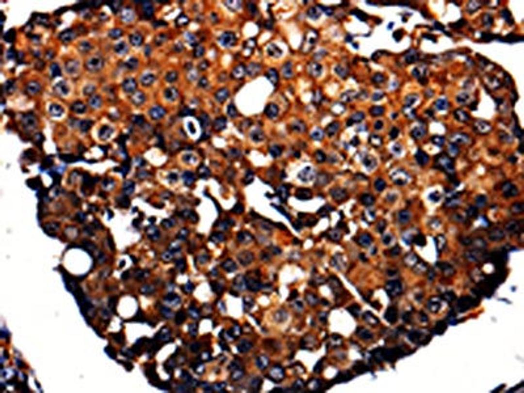 The image is immunohistochemistry of paraffin-embedded Human breast cancer tissue using CSB-PA828204(APLP1 Antibody) at dilution 1/10. (Original magnification: ×200)