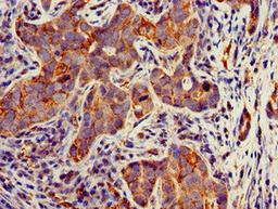 Immunohistochemistry of paraffin-embedded human pancreatic cancer using CSB-PA023369LA01HU at dilution of 1:100