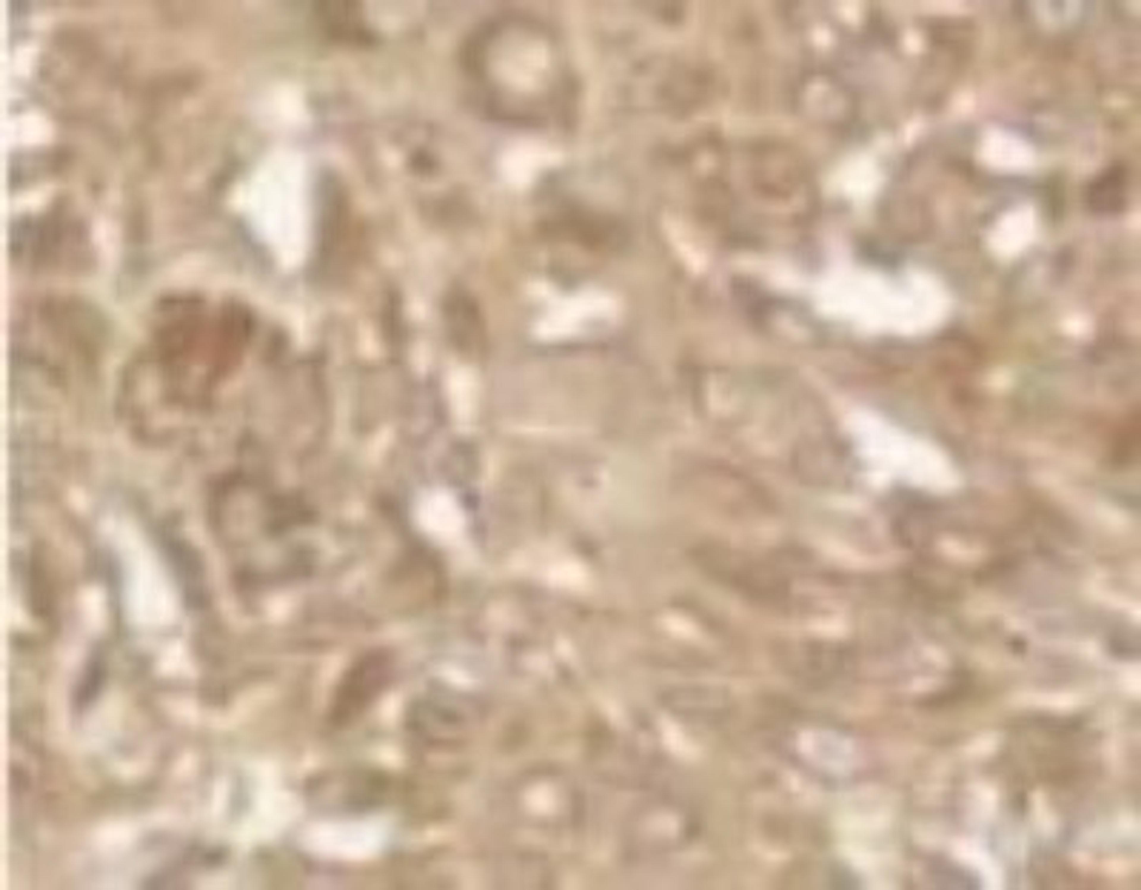 Immunohistochemistry: PUMA Antibody [NB100-56370] - PUMA expression in human dysplastic nevi (premalignant melanoma).