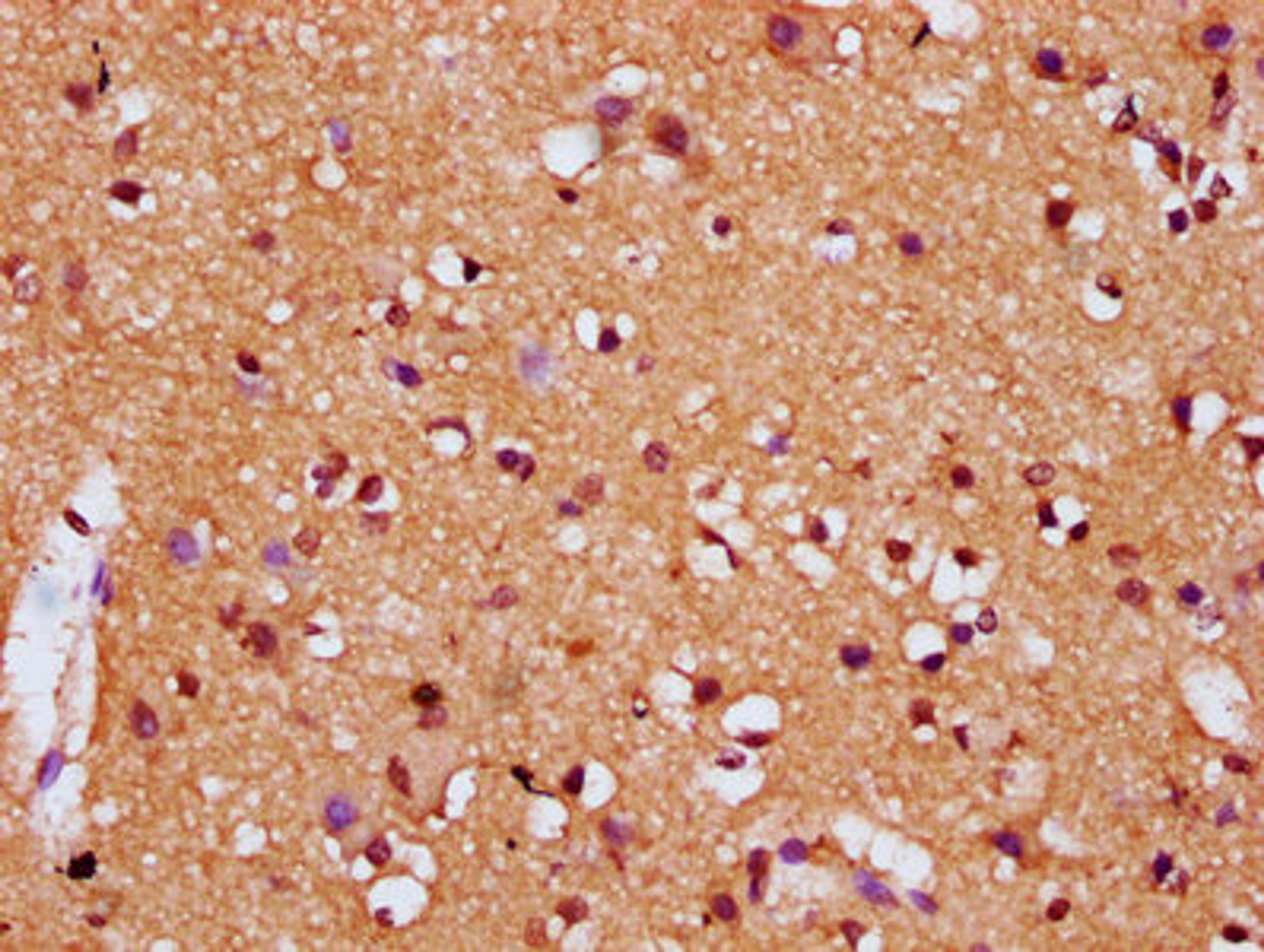 IHC image of CSB-PA006905LA01HU diluted at 1:200 and staining in paraffin-embedded human brain tissue performed on a Leica BondTM system. After dewaxing and hydration, antigen retrieval was mediated by high pressure in a citrate buffer (pH 6.0). Section was blocked with 10% normal goat serum 30min at RT. Then primary antibody (1% BSA) was incubated at 4°C overnight. The primary is detected by a biotinylated secondary antibody and visualized using an HRP conjugated SP system.