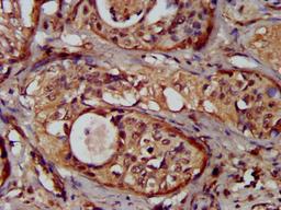 IHC image of CSB-PA897595LA01HU diluted at 1:300 and staining in paraffin-embedded human cervical cancer performed on a Leica BondTM system. After dewaxing and hydration, antigen retrieval was mediated by high pressure in a citrate buffer (pH 6.0). Section was blocked with 10% normal goat serum 30min at RT. Then primary antibody (1% BSA) was incubated at 4&deg;C overnight. The primary is detected by a biotinylated secondary antibody and visualized using an HRP conjugated SP system.