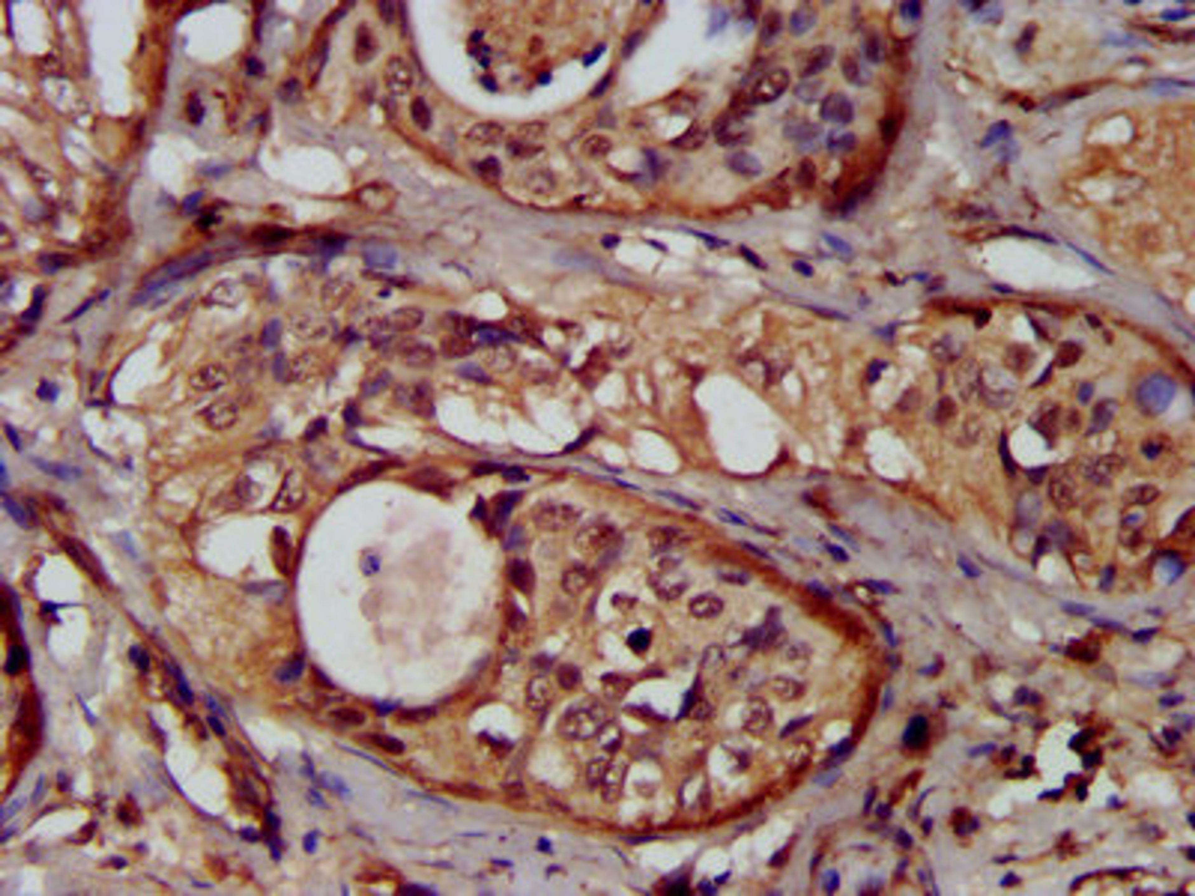 IHC image of CSB-PA897595LA01HU diluted at 1:300 and staining in paraffin-embedded human cervical cancer performed on a Leica BondTM system. After dewaxing and hydration, antigen retrieval was mediated by high pressure in a citrate buffer (pH 6.0). Section was blocked with 10% normal goat serum 30min at RT. Then primary antibody (1% BSA) was incubated at 4&deg;C overnight. The primary is detected by a biotinylated secondary antibody and visualized using an HRP conjugated SP system.