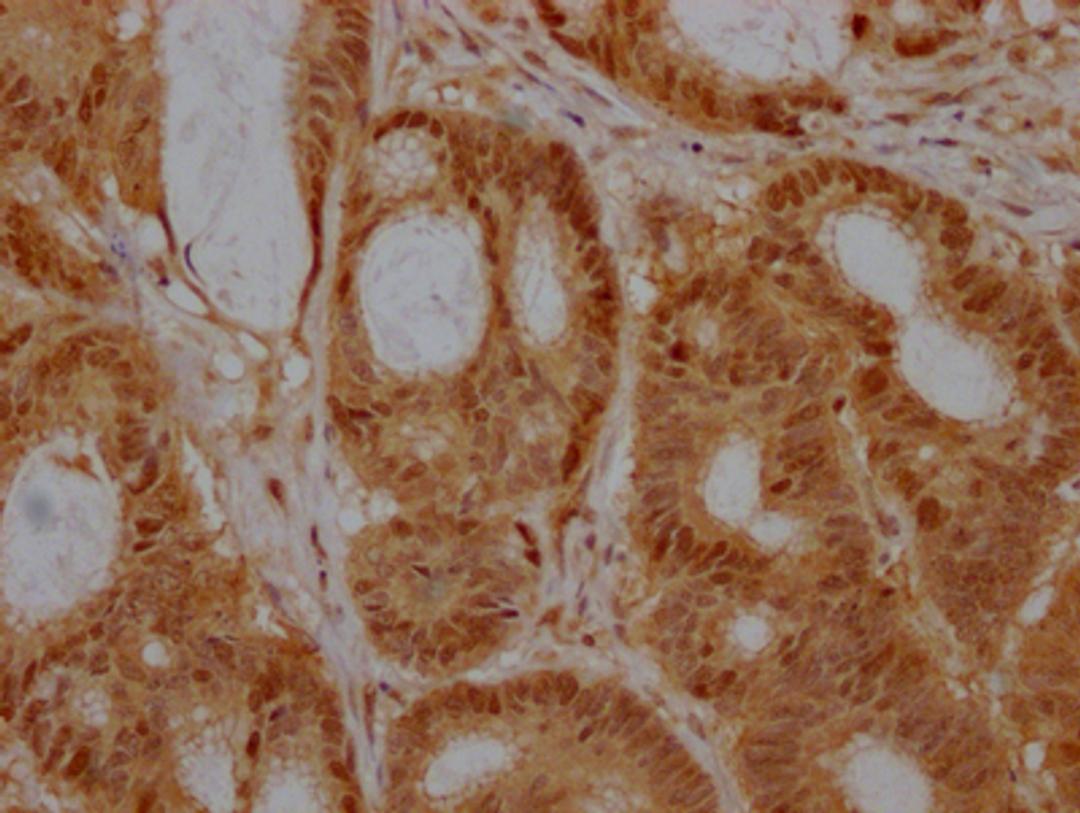 IHC image of CSB-RA218051A0HU diluted at 1:100 and staining in paraffin-embedded human colon cancer performed on a Leica BondTM system. After dewaxing and hydration, antigen retrieval was mediated by high pressure in a citrate buffer (pH 6.0). Section was blocked with 10% normal goat serum 30min at RT. Then primary antibody (1% BSA) was incubated at 4℃ overnight. The primary is detected by a Goat anti-rabbit IgG polymer labeled by HRP and visualized using 0.05% DAB.