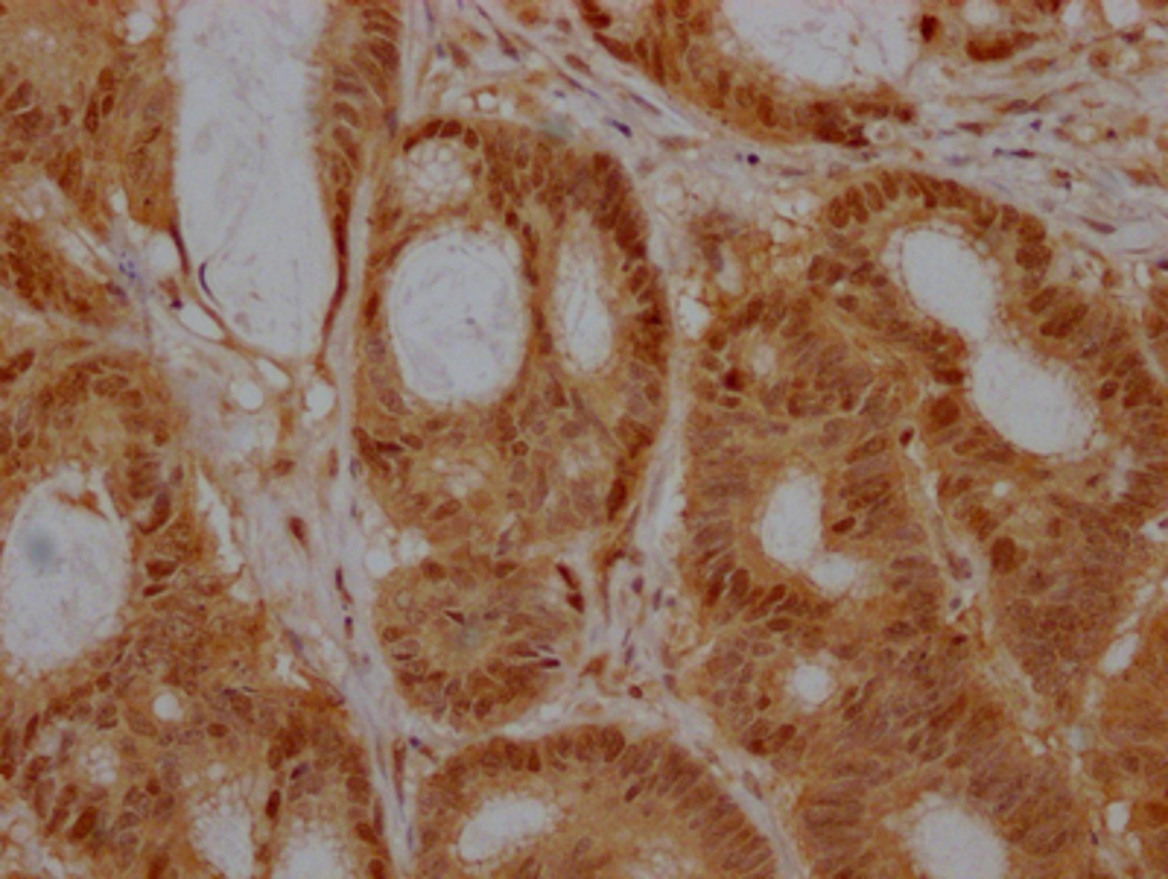 IHC image of CSB-RA218051A0HU diluted at 1:100 and staining in paraffin-embedded human colon cancer performed on a Leica BondTM system. After dewaxing and hydration, antigen retrieval was mediated by high pressure in a citrate buffer (pH 6.0). Section was blocked with 10% normal goat serum 30min at RT. Then primary antibody (1% BSA) was incubated at 4℃ overnight. The primary is detected by a Goat anti-rabbit IgG polymer labeled by HRP and visualized using 0.05% DAB.