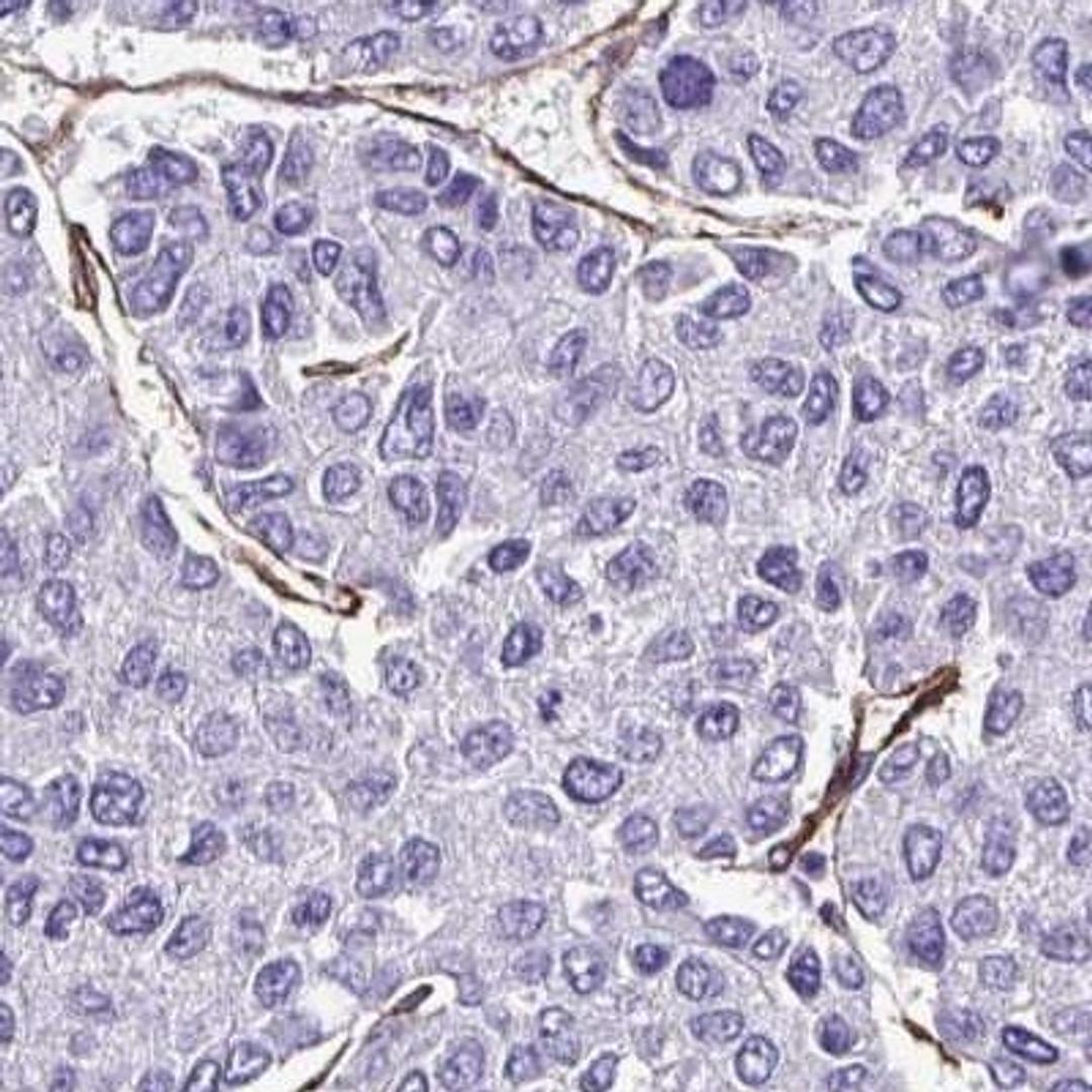 Immunohistochemistry: FBXO34 Antibody [NBP2-31919] - liver cancer