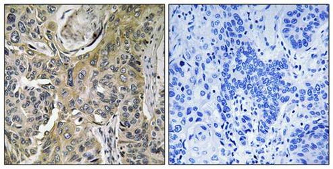 Immunohistochemical analysis of formalin-fixed and paraffin-embedded human lung carcinoma tissue using RHOBTB3 antibody