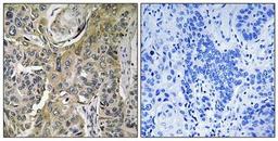 Immunohistochemical analysis of formalin-fixed and paraffin-embedded human lung carcinoma tissue using RHOBTB3 antibody