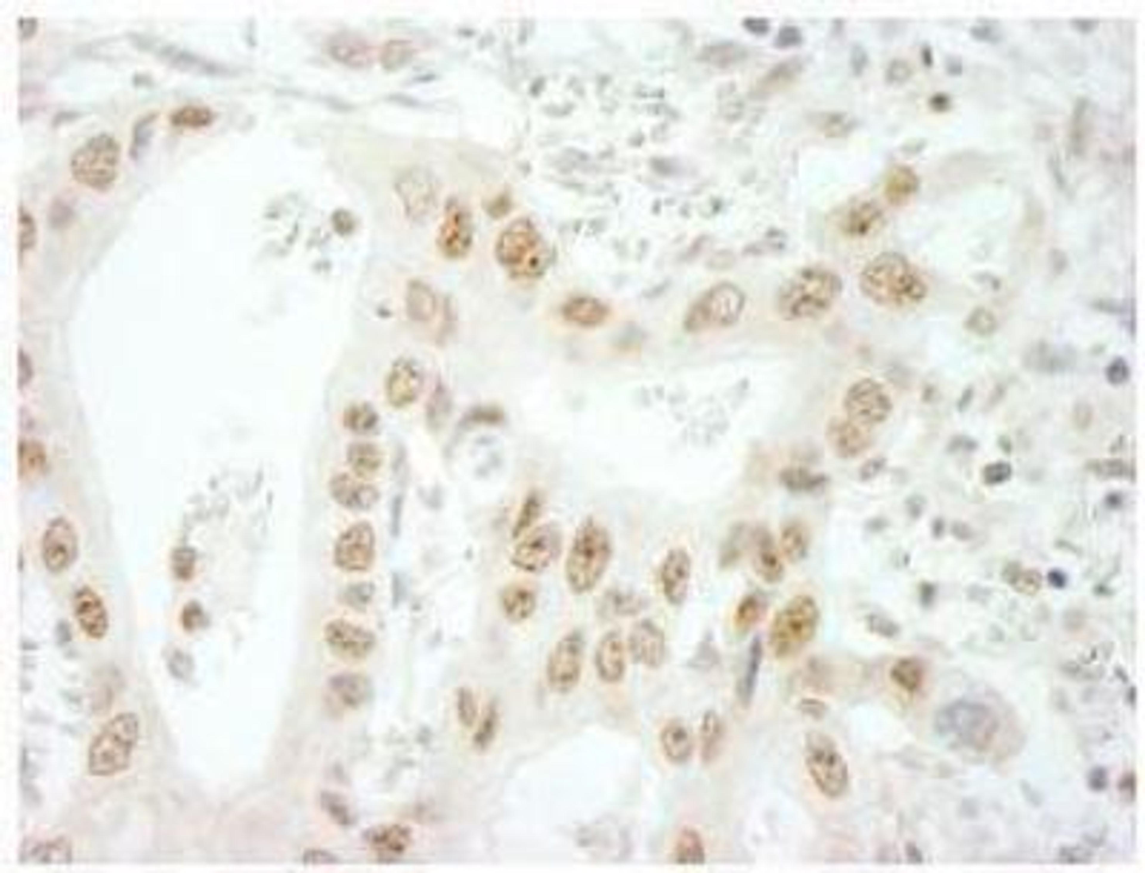 Immunohistochemistry-Paraffin: SKIV2L2 Antibody [NB100-1574] - Detection of Human SKIV2L2 by Immunohistochemistry. Sample: FFPE section of human lung adenocarcinoma. Antibody: Affinity purified rabbit anti-SKIV2L2 used at a dilution of 1:250. Detection: DAB staining using Immunohistochemistry Accessory Kit. Epitope Retrieval Buffer-High pH was substituted for Epitope Retrieval Buffer-Reduced pH.