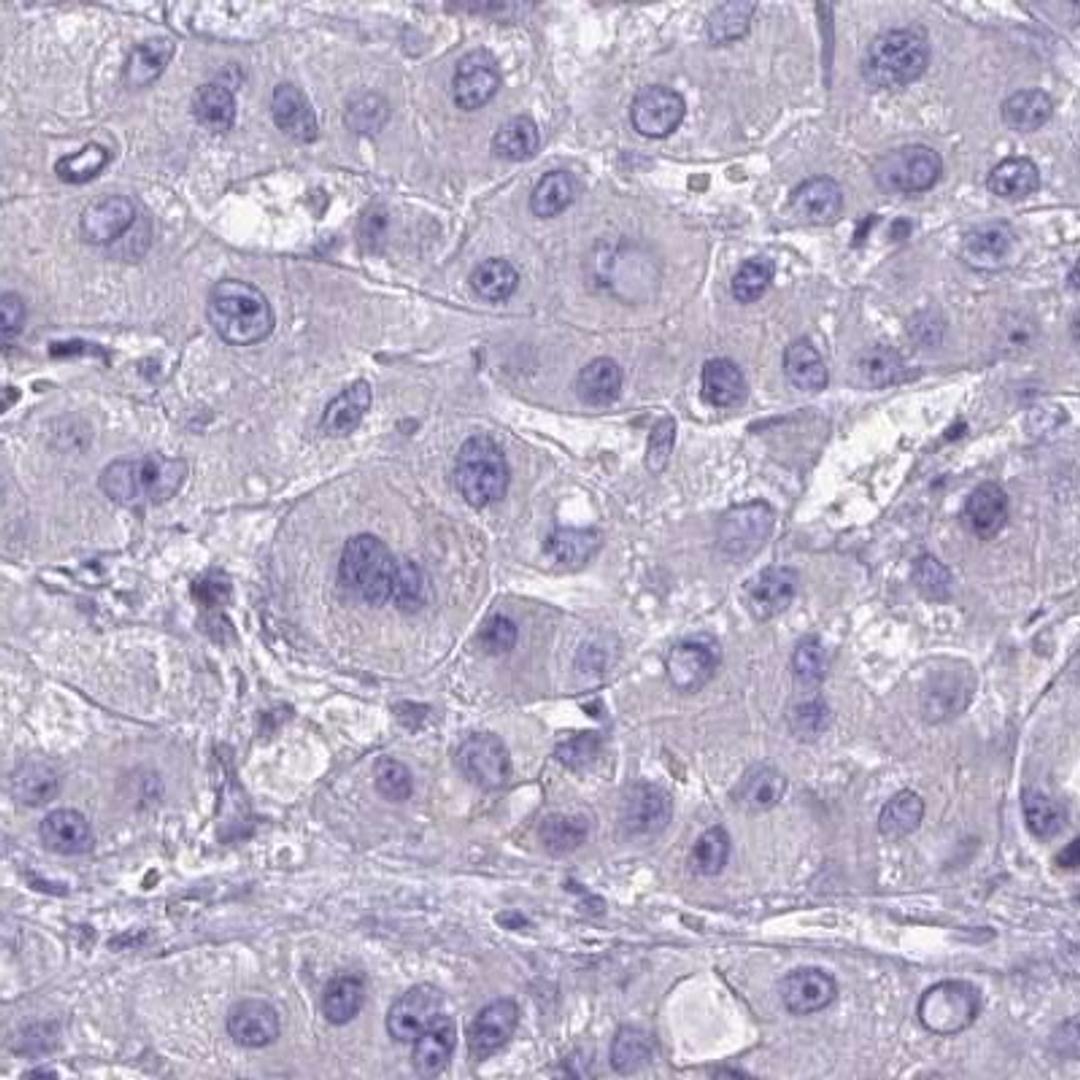 Immunohistochemistry: TR2IT1 Antibody [NBP2-31707] - liver cancer