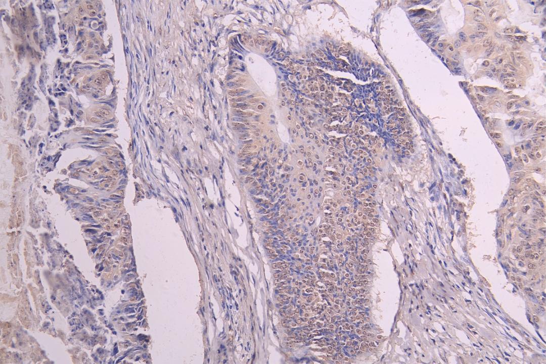 IHC image of CSB-RA009892MA1HU diluted at 1：100 and staining in paraffin-embedded human colon cancer performed on a Leica BondTM system. After dewaxing and hydration, antigen retrieval was mediated by high pressure in a citrate buffer (pH 6.0). Section was blocked with 10% normal goat serum 30min at RT. Then primary antibody (1% BSA) was incubated at 4°C overnight. The primary is detected by a Goat anti-human polymer IgG labeled by HRP and visualized using 0.05% DAB.