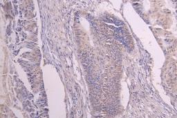 IHC image of CSB-RA009892MA1HU diluted at 1：100 and staining in paraffin-embedded human colon cancer performed on a Leica BondTM system. After dewaxing and hydration, antigen retrieval was mediated by high pressure in a citrate buffer (pH 6.0). Section was blocked with 10% normal goat serum 30min at RT. Then primary antibody (1% BSA) was incubated at 4°C overnight. The primary is detected by a Goat anti-human polymer IgG labeled by HRP and visualized using 0.05% DAB.