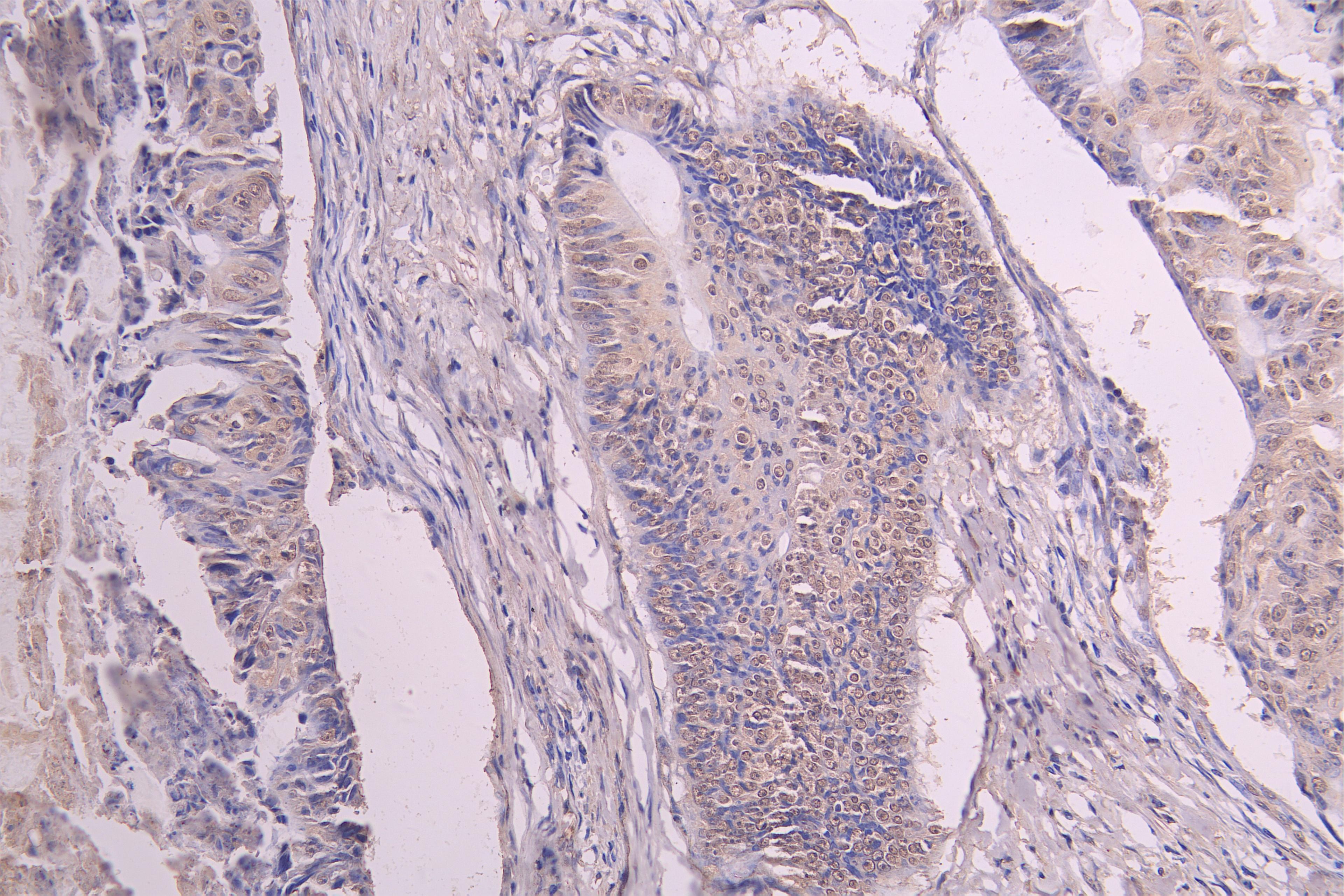 IHC image of CSB-RA009892MA1HU diluted at 1：100 and staining in paraffin-embedded human colon cancer performed on a Leica BondTM system. After dewaxing and hydration, antigen retrieval was mediated by high pressure in a citrate buffer (pH 6.0). Section was blocked with 10% normal goat serum 30min at RT. Then primary antibody (1% BSA) was incubated at 4°C overnight. The primary is detected by a Goat anti-human polymer IgG labeled by HRP and visualized using 0.05% DAB.