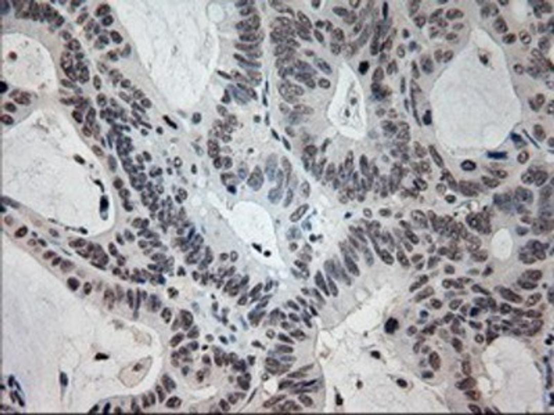 Immunohistochemistry-Paraffin: Prominin 2 Antibody (6B7) [NBP1-47938] - Staining of paraffin-embedded Adenocarcinoma of colon tissue using anti-Prominin 2mouse monoclonal antibody.