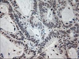 Immunohistochemistry-Paraffin: Prominin 2 Antibody (6B7) [NBP1-47938] - Staining of paraffin-embedded Adenocarcinoma of colon tissue using anti-Prominin 2mouse monoclonal antibody.