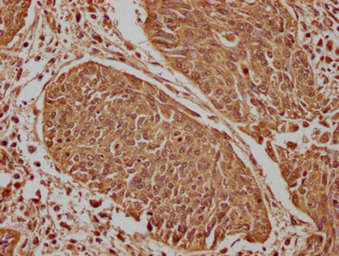 IHC image of CSB-PA666060LA01HU diluted at 1:100 and staining in paraffin-embedded human cervical cancer performed on a Leica BondTM system. After dewaxing and hydration, antigen retrieval was mediated by high pressure in a citrate buffer (pH 6.0). Section was blocked with 10% normal goat serum 30min at RT. Then primary antibody (1% BSA) was incubated at 4°C overnight. The primary is detected by a biotinylated secondary antibody and visualized using an HRP conjugated SP system.