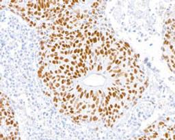 Detection of human MSH2 in FFPE lung carcinoma by immunohistochemistry.