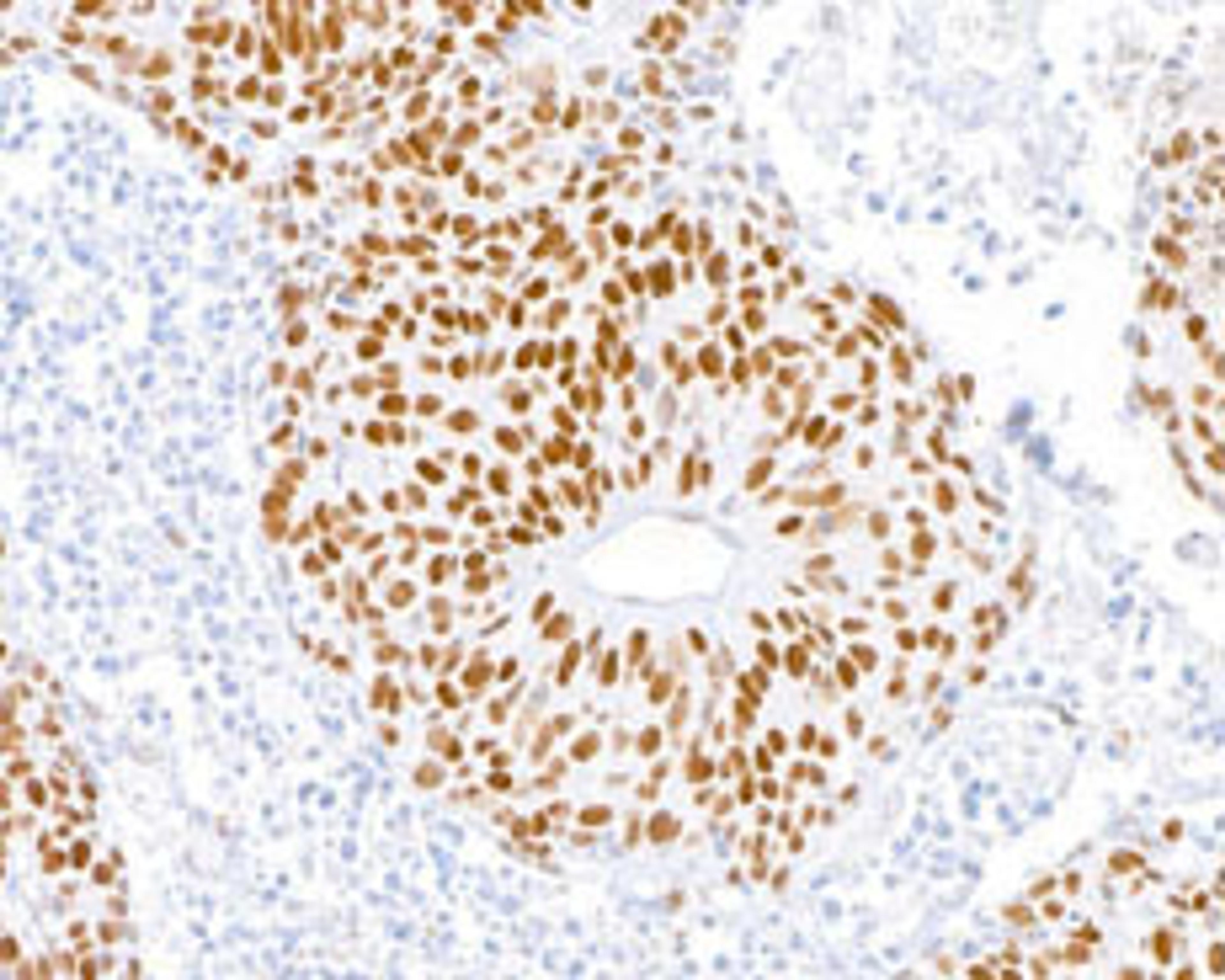 Detection of human MSH2 in FFPE lung carcinoma by immunohistochemistry.