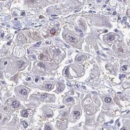 Immunohistochemistry: ABHD16B Antibody [NBP2-31761] - liver cancer