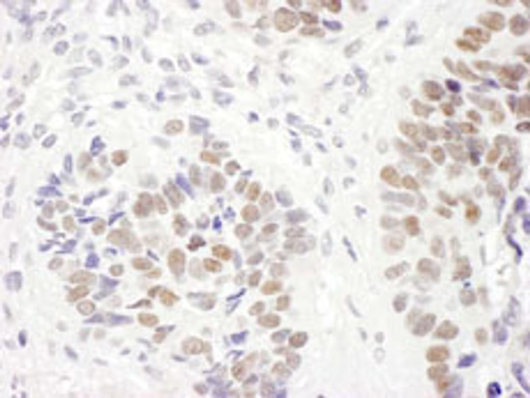 Detection of human MSH6 by immunohistochemistry.