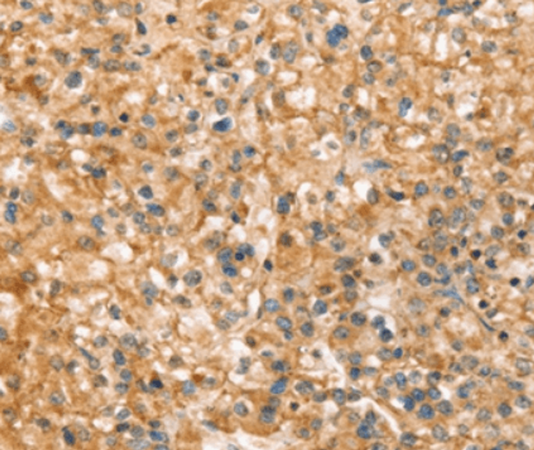 Immunohistochemical analysis of paraffin-embedded Human prostate cancer tissue using SLC43A2 antibody