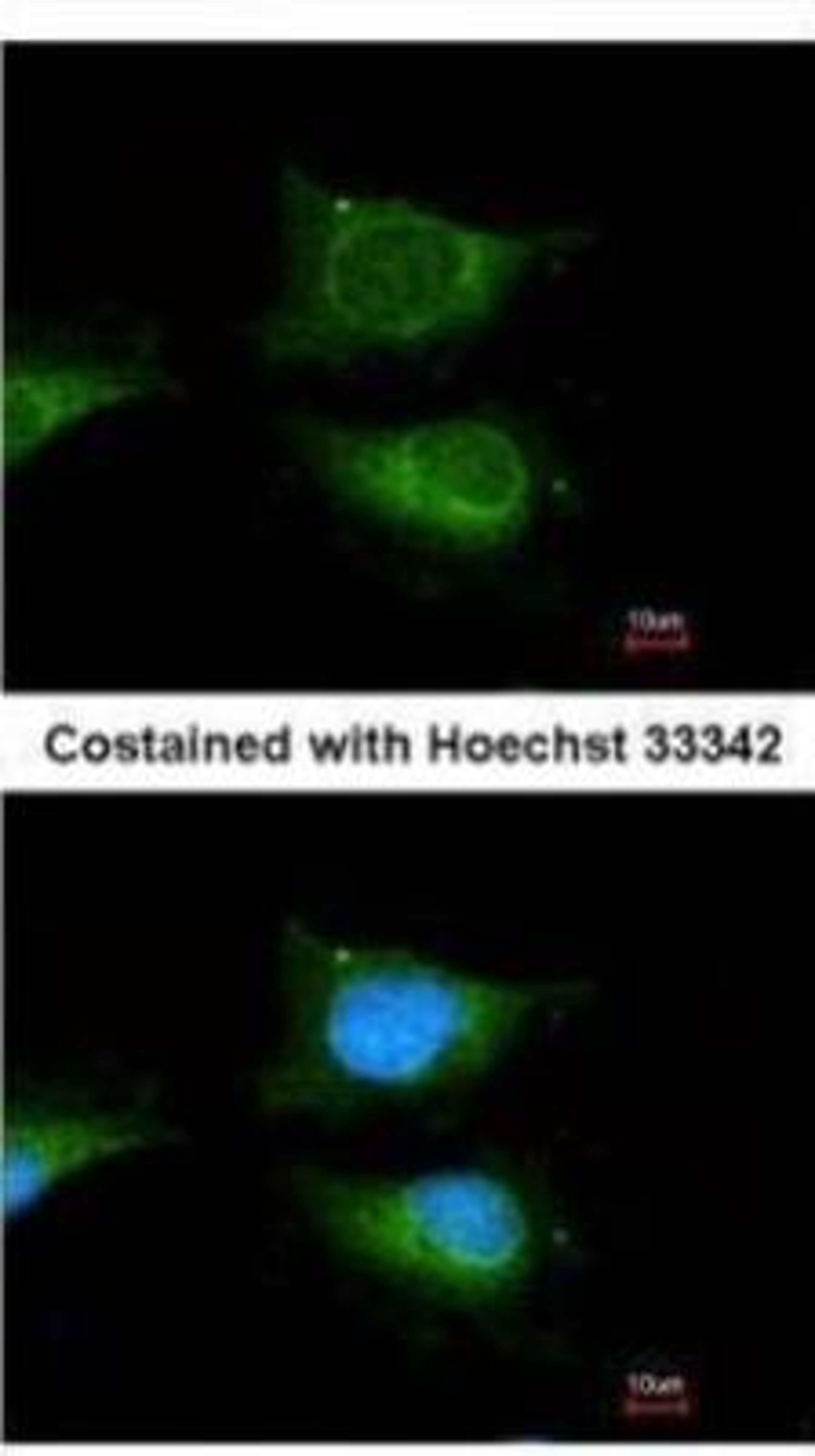 Immunocytochemistry/Immunofluorescence: Glucosylceramidase/GBA Antibody [NBP1-32271] - Paraffin-embedded human lung cancer, using GBA antibody at 1:100 dilution.