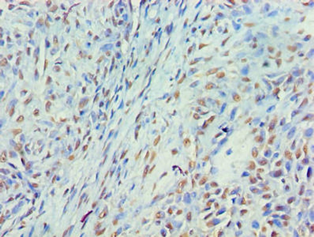 Immunohistochemistry of paraffin-embedded human breast cancer using CSB-PA015283LA01HU at dilution of 1:100