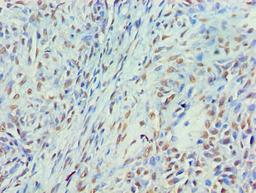 Immunohistochemistry of paraffin-embedded human breast cancer using CSB-PA015283LA01HU at dilution of 1:100