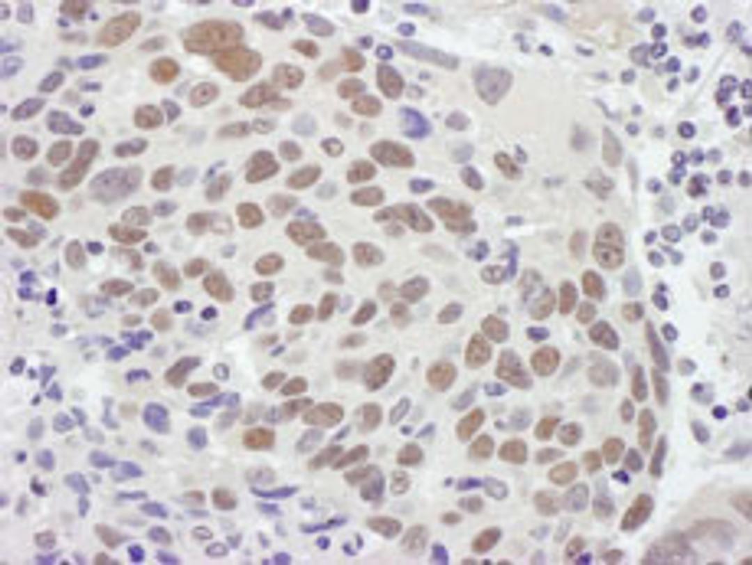 Detection of human MSH2 by immunohistochemistry.