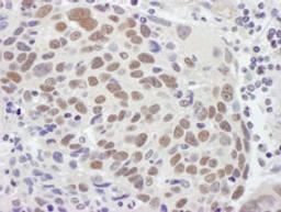 Detection of human MSH2 by immunohistochemistry.